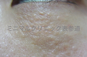 汗管腫