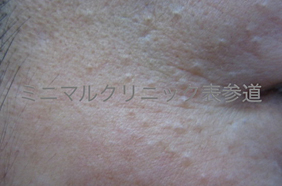 エクリン汗嚢腫