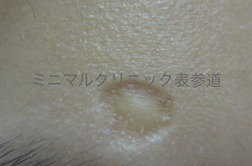 水疱瘡跡